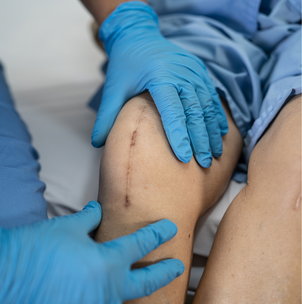 My Approach to Failed Knee Replacements